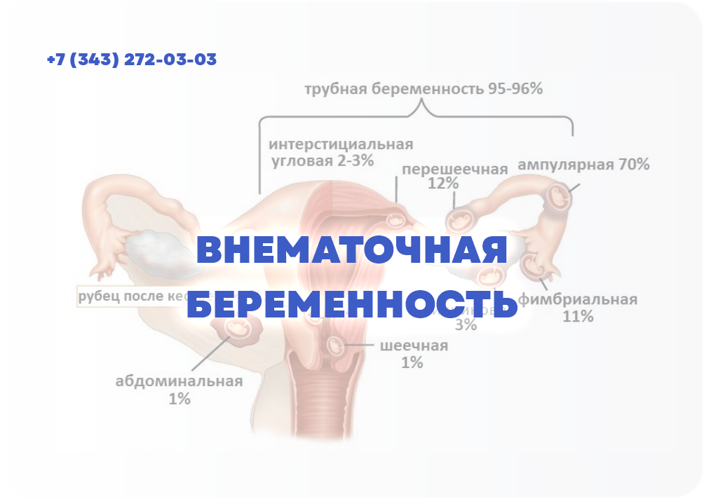 ВНЕМАТОЧНАЯ БЕРЕМЕННОСТЬ