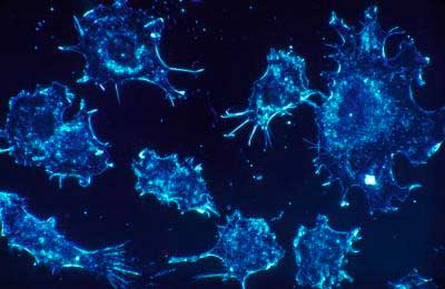 Кальцитонин | MyPathologyReport.ca