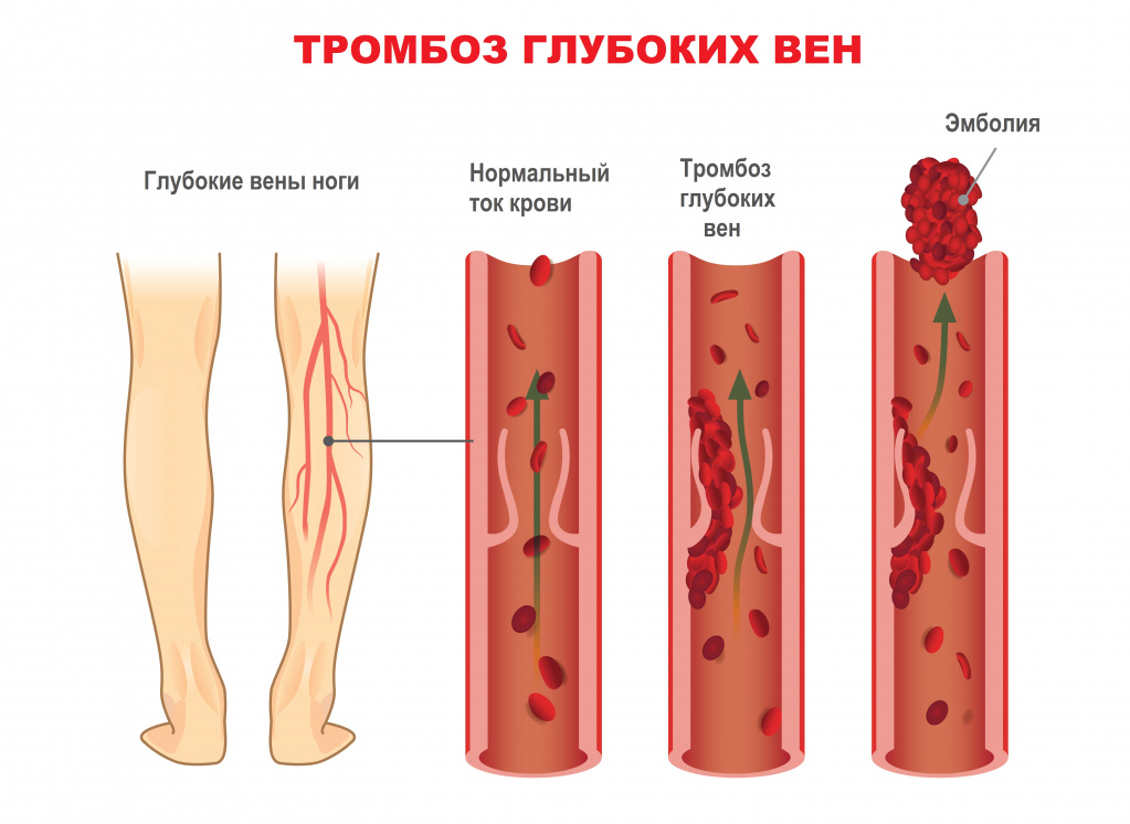 Тромбофилия - причины появления, симптомы заболевания, диагностика и способы лечения