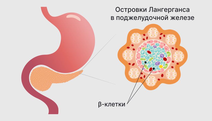Сахарный диабет 1 типа (инсулинозависимый диабет) - причины и симптомы
